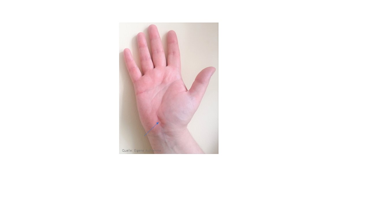 Foto einer Hand mit Ergebnis der Wundheilung 8 Wochen nach der Operation des Karpaltunnelsyndroms